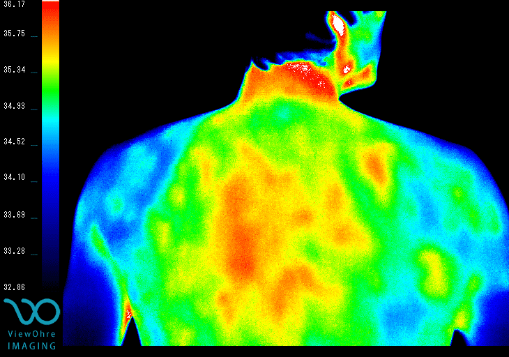 Back Thermography