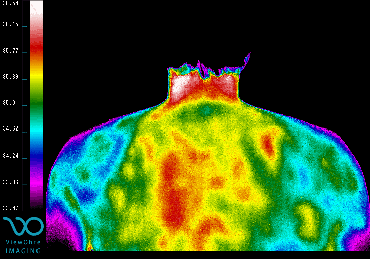 Back Thermography