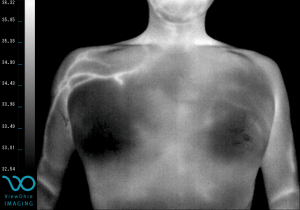 shoulder_pectoral_pain