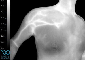 shoulder_pectoral_pain