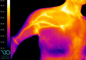 shoulder_pectoral_pain